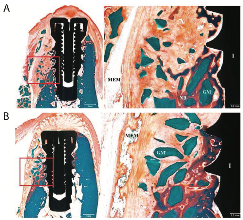Membranes for Guided Bone Regeneration LVTS UMRS1148 INSERM UP Cité USPN